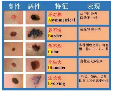 灰色痣|痣